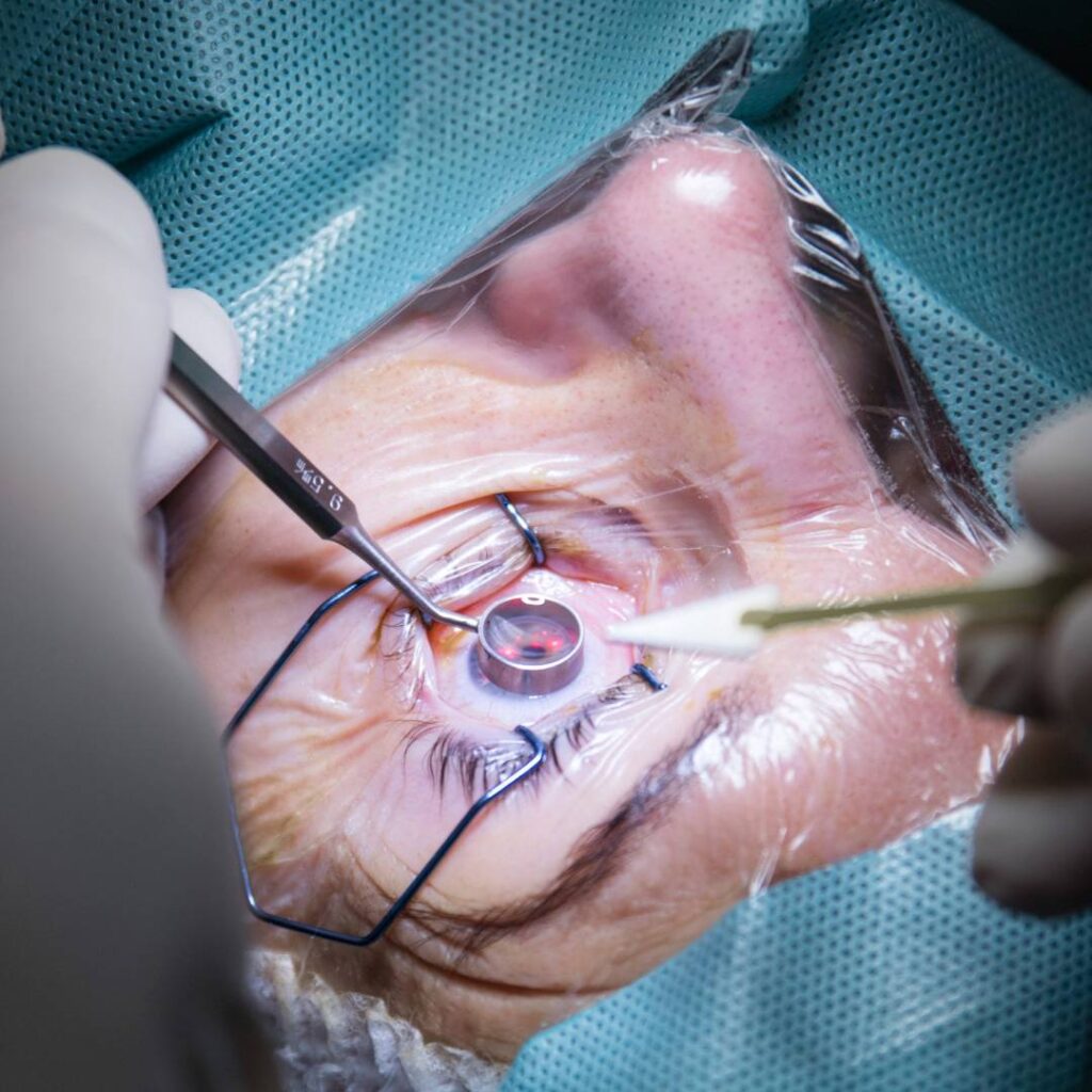 Corneal Refractive Surgery