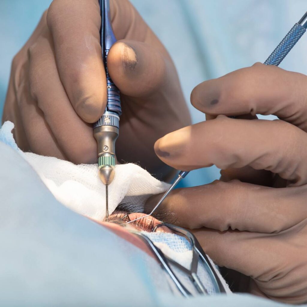 Phacoemulsification