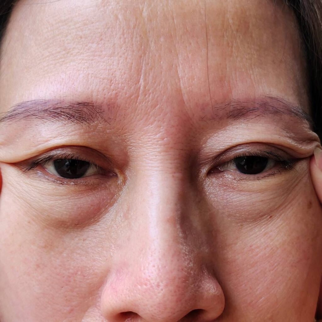 Ptosis Surgery